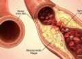 Giant Fat Particles Fuel Atherosclerosis in Mice, Defying Old Heart Disease Dogma