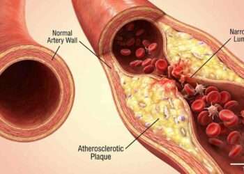 Giant Fat Particles Fuel Atherosclerosis in Mice, Defying Old Heart Disease Dogma